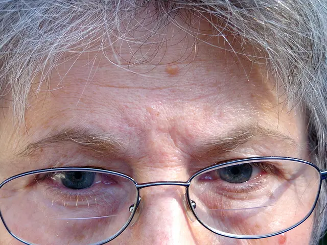 Research Reveals that Contact Lenses Contribute to Reduced Myopia Advancement